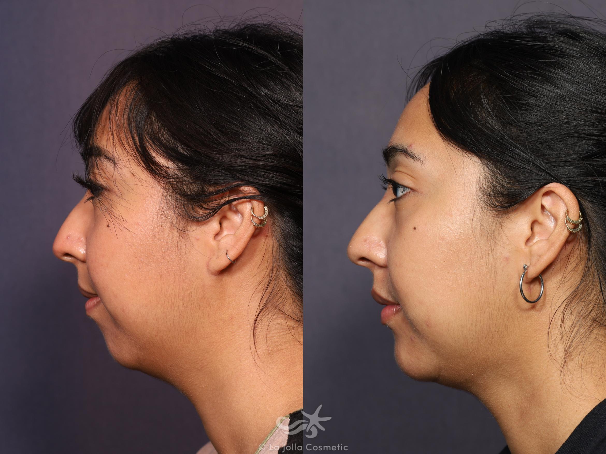 Before & After Neck Liposuction Result 715 Left Side View in San Diego, CA