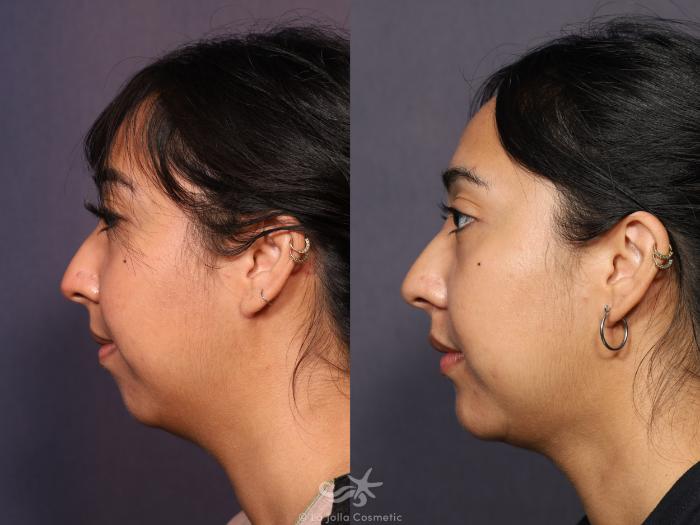 Before & After Neck Liposuction Result 715 Left Side View in San Diego, Carlsbad, CA
