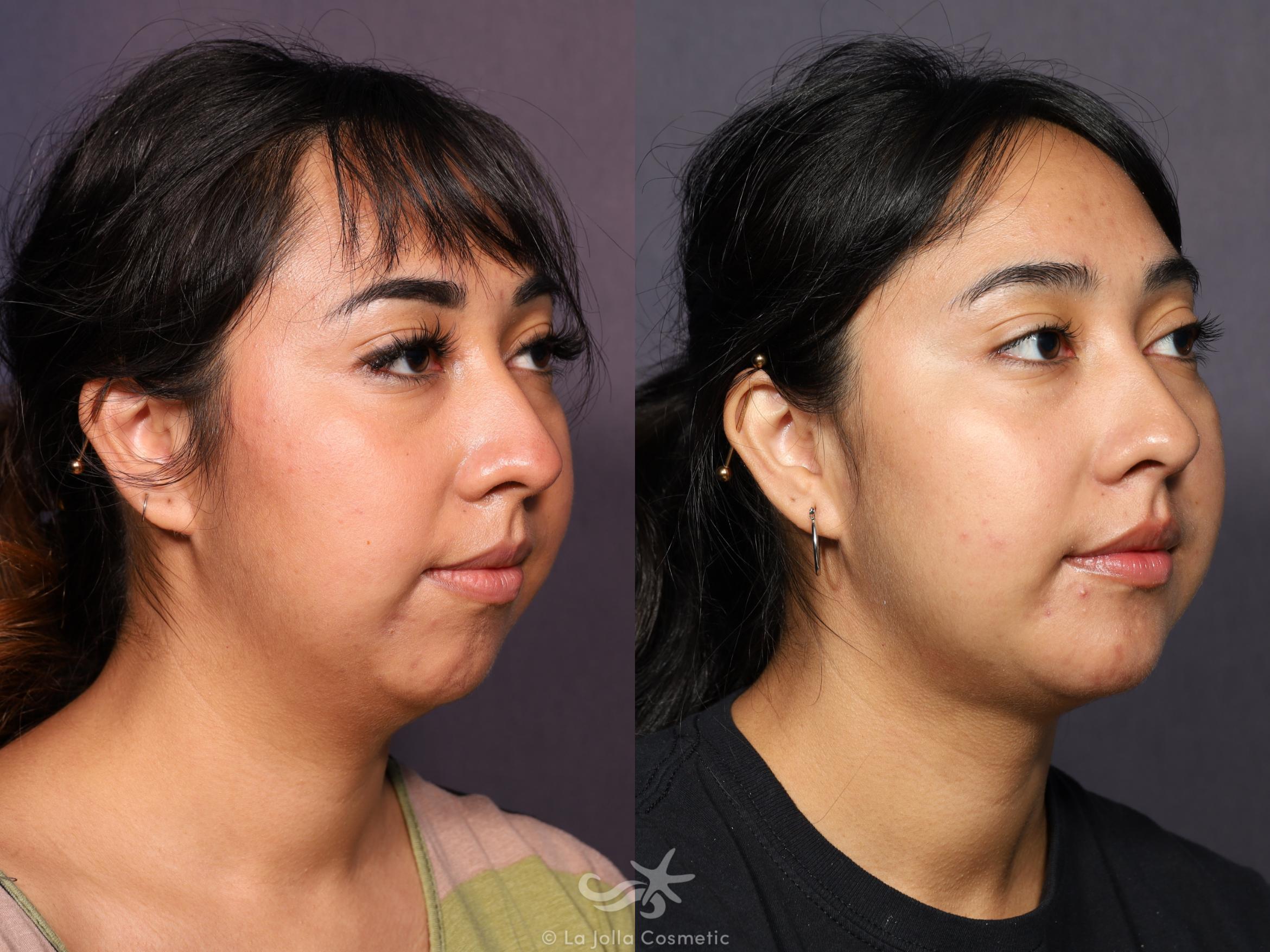 Before & After Neck Liposuction Result 715 Right Oblique View in San Diego, CA
