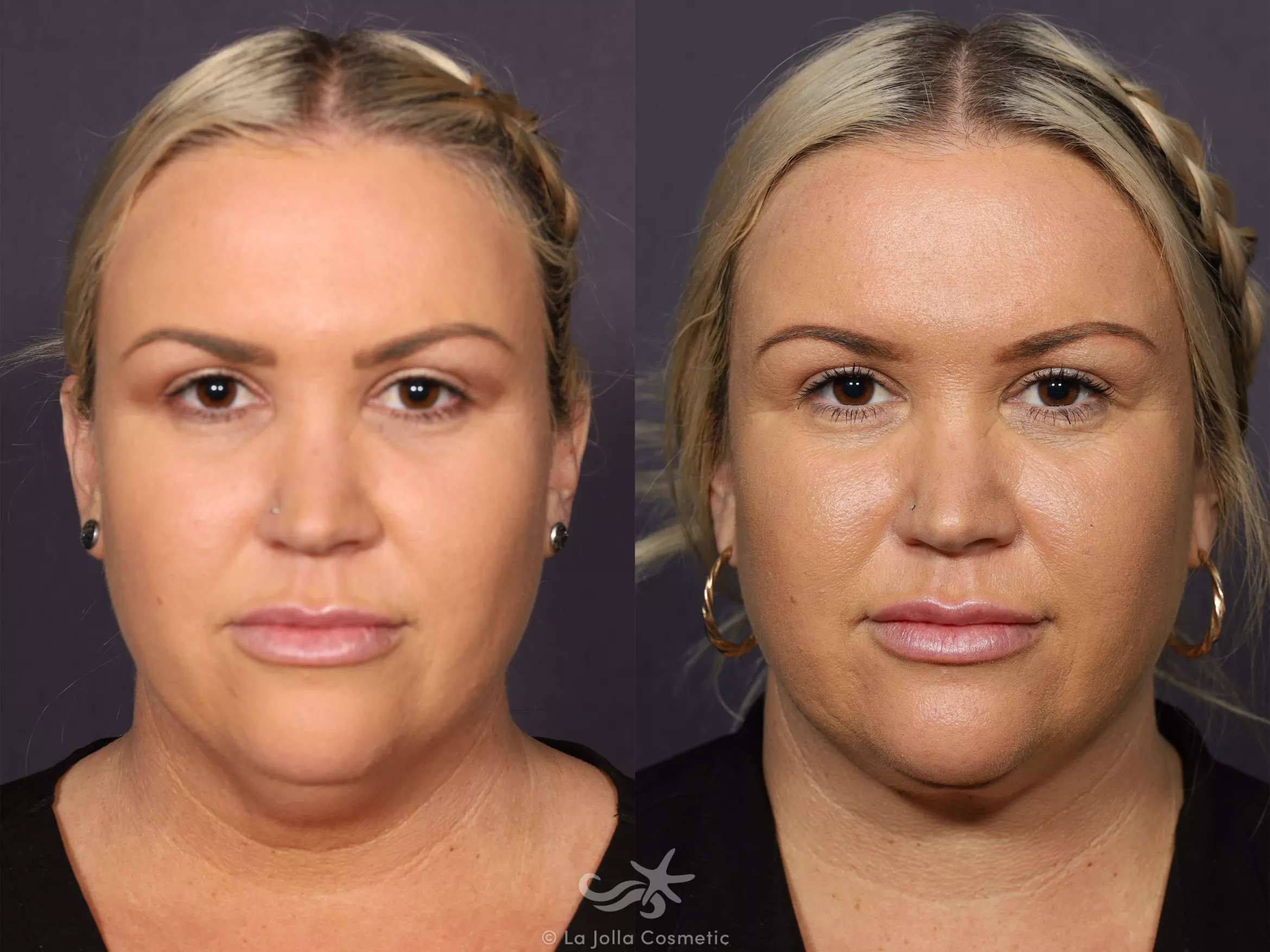 Before & After Neck Liposuction Result 729 Front View in San Diego, CA