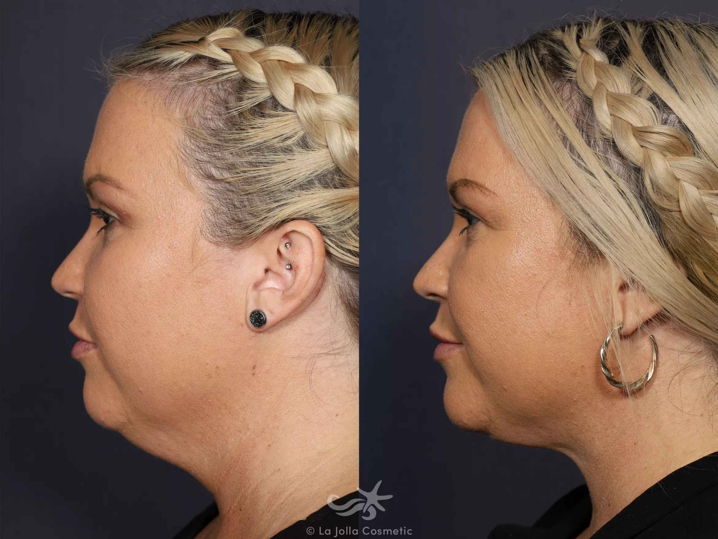 Before & After Neck Liposuction Result 729 Left Side View in San Diego, CA