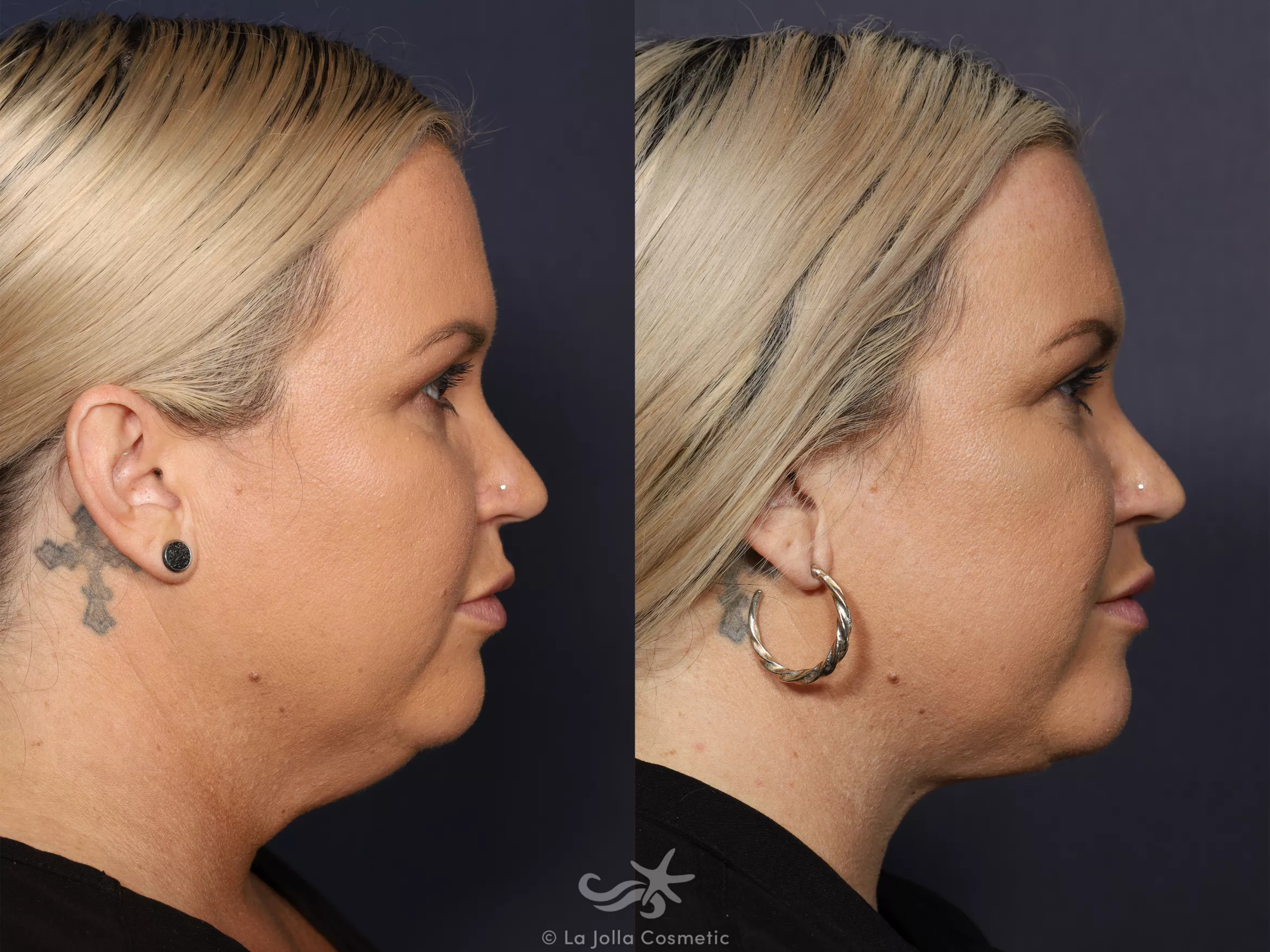 Before & After Neck Liposuction Result 729 Right Side View in San Diego, CA