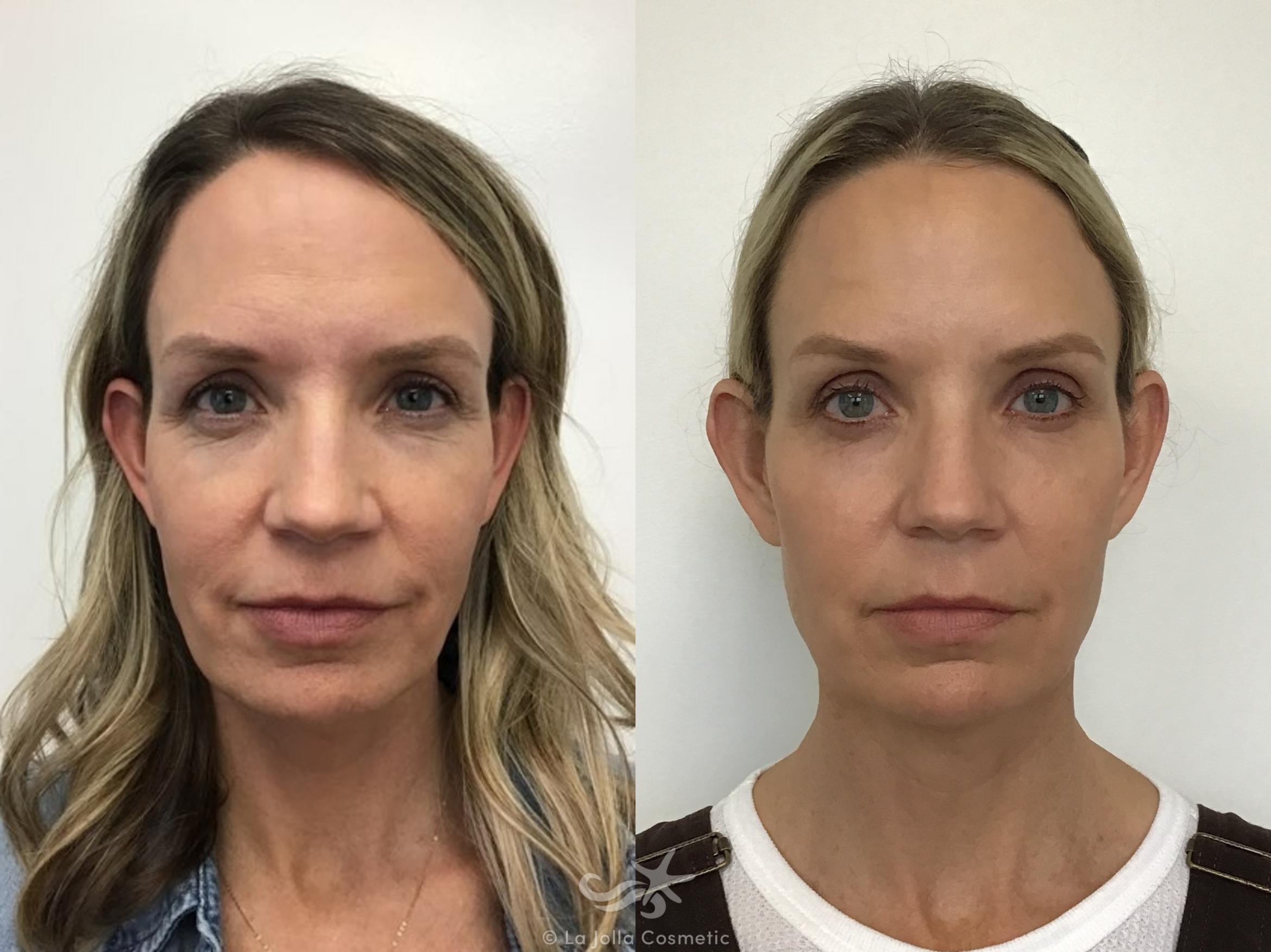 Before & After JUVÉDERM® VOLUMA™ Result 590 Front View in San Diego, CA