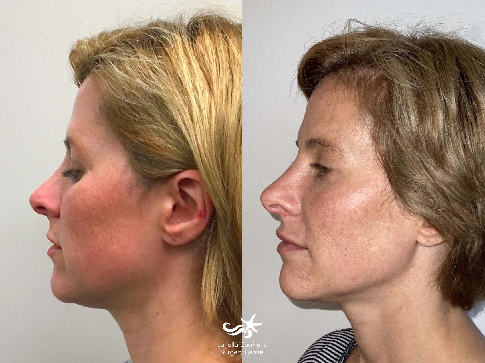 NovaThreads Before and After Pictures Result 718 San Diego, CA La