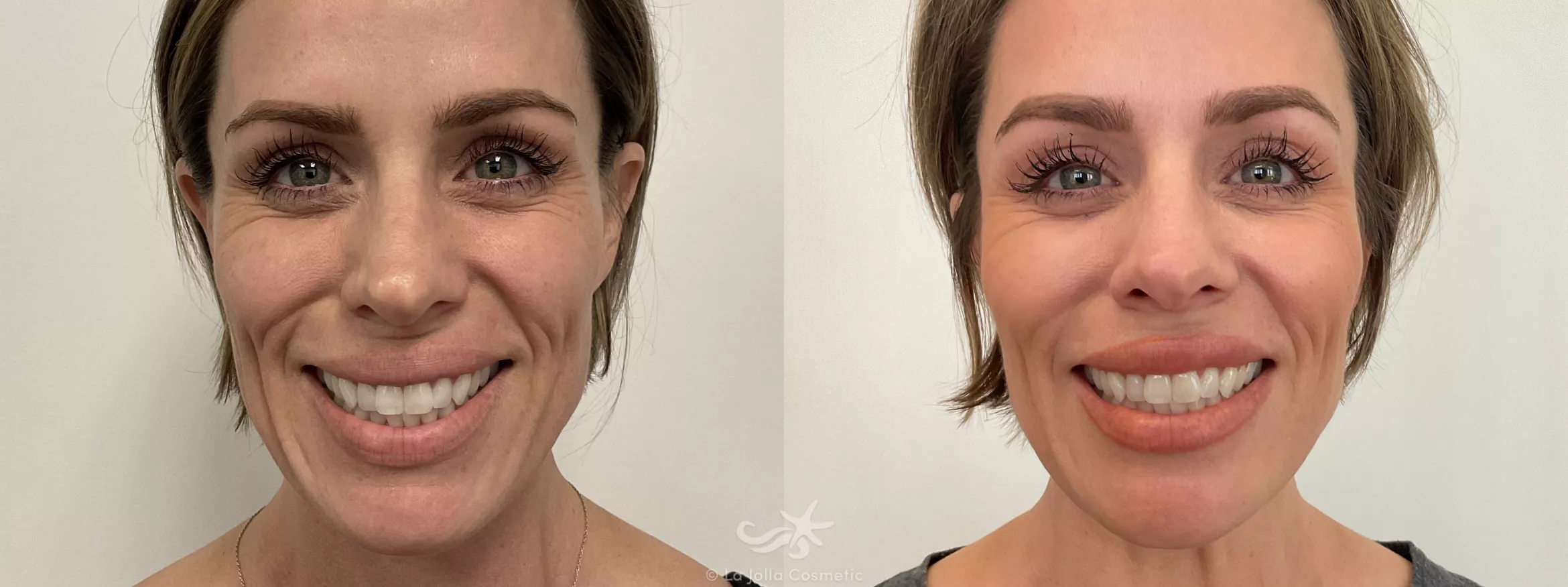 Before & After BOTOX® Cosmetic Result 750 Front Smile View in San Diego, CA