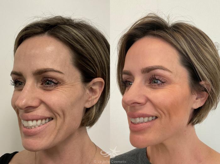 Before & After NovaThreads Result 750 Left Smile View in San Diego, Carlsbad, CA