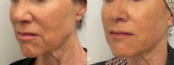Before & After NovaThreads Result 769 Left Oblique View in San Diego, Carlsbad, CA