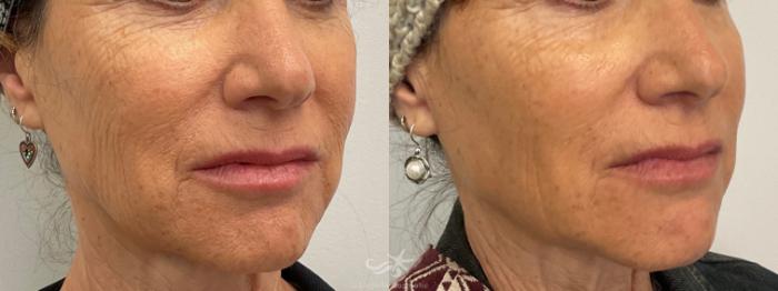 Before & After NovaThreads Result 769 Right Oblique View in San Diego, Carlsbad, CA
