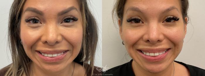 Before & After NovaThreads Result 770 Front Smile View in San Diego, Carlsbad, CA