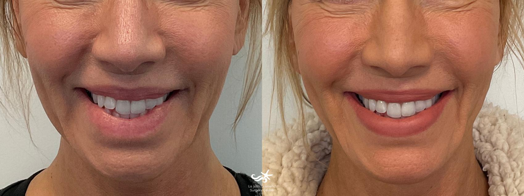 NovaThreads Before and After Pictures Result 774 San Diego, Carlsbad