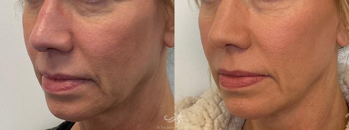 Before & After NovaThreads Result 774 Left Oblique View in San Diego, Carlsbad, CA