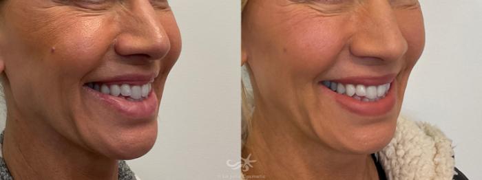 Before & After NovaThreads Result 774 Right Oblique View in San Diego, Carlsbad, CA