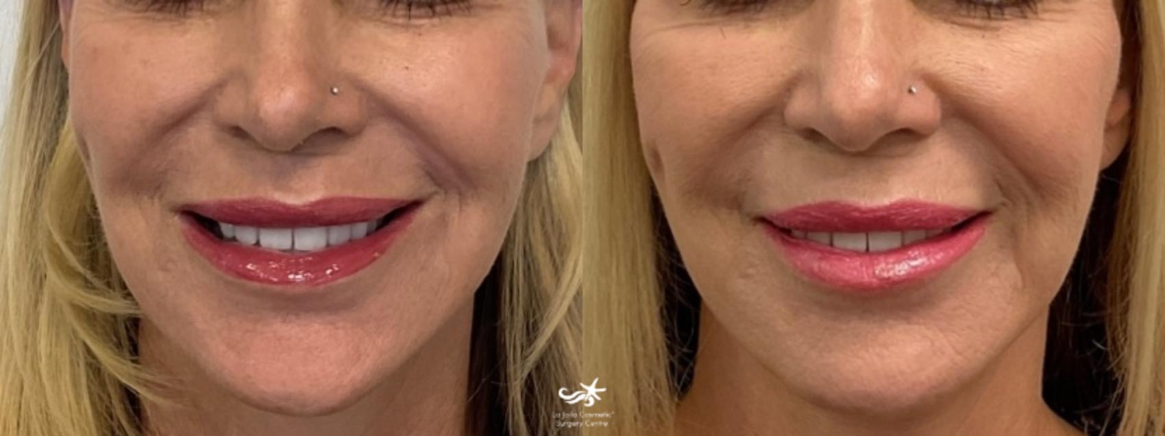 NovaThreads Before and After Pictures Result 779 San Diego, Carlsbad