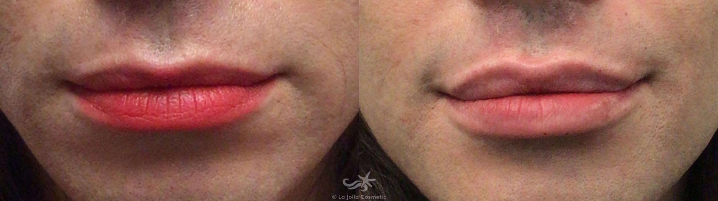 Before & After Restylane® Result 602 Front View in San Diego, CA
