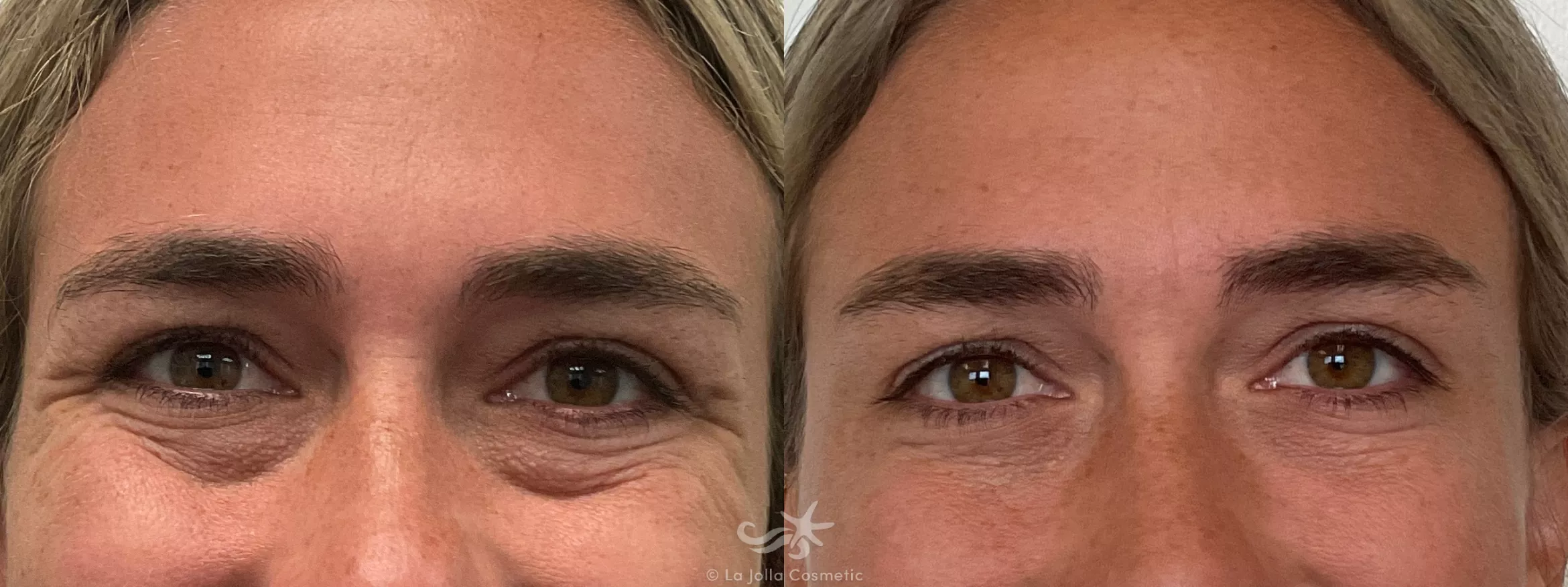 Before & After Restylane® Result 706 Front View in San Diego, CA