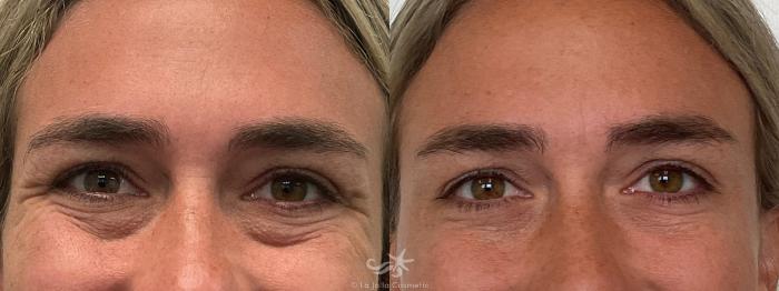 Before & After Restylane® Result 706 Front View in San Diego, Carlsbad, CA