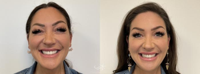 Before & After Restylane® Result 846 Front View in San Diego, Carlsbad, CA