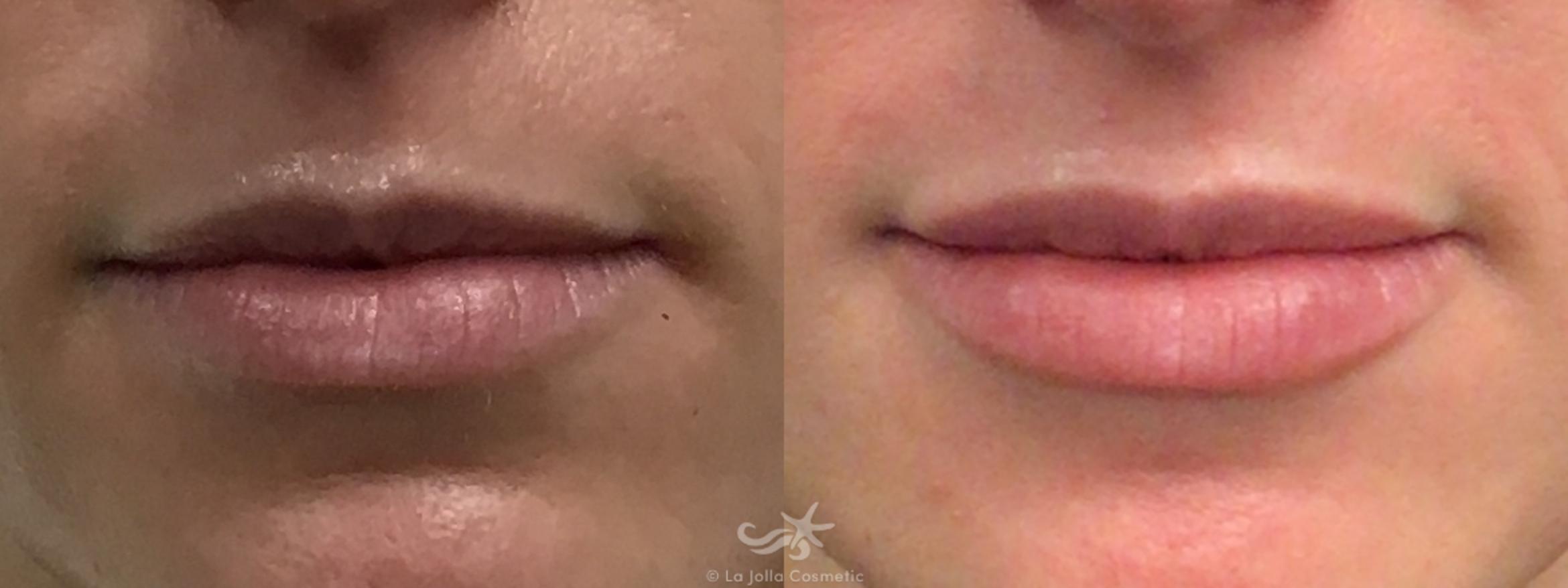 Before & After Restylane® Defyne Result 660 Front View in San Diego, CA