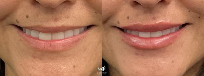 Flanks Before & After Gallery - Bakersfield, CA: Esla Oral & Facial Surgery