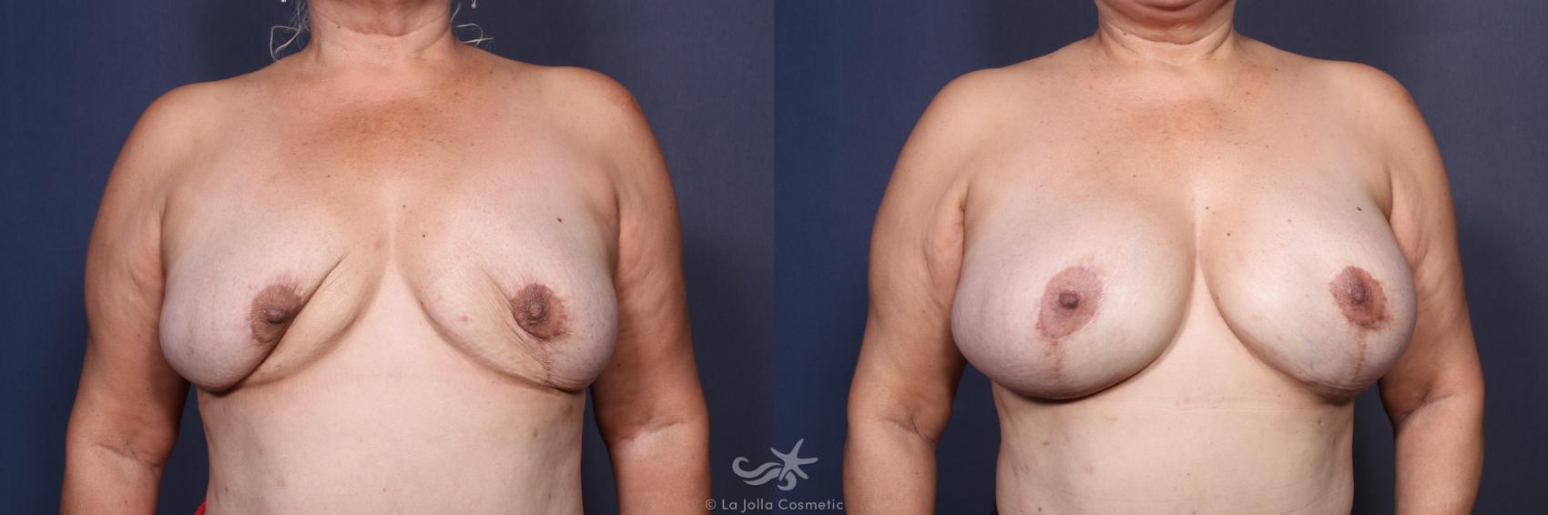 Before & After Revision Breast Surgery Result 126 Front View in San Diego, CA