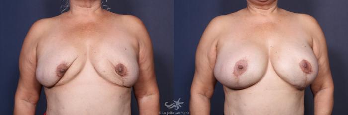 Before & After Revision Breast Surgery Result 126 Front View in San Diego, Carlsbad, CA