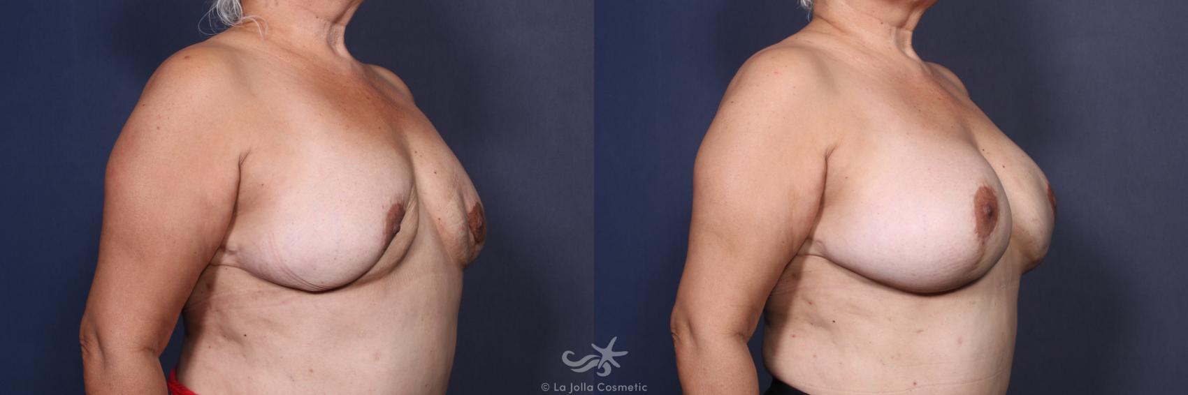 Before & After Revision Breast Surgery Result 126 Right Oblique View in San Diego, CA