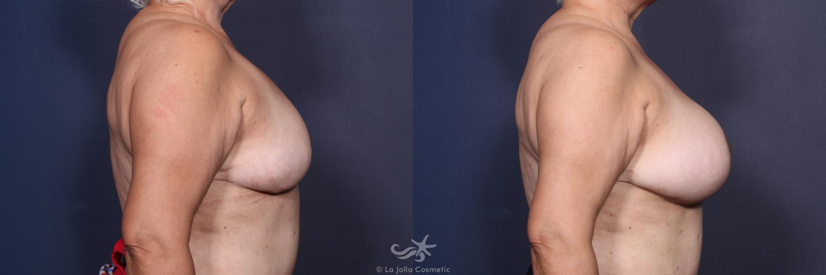 Before & After Revision Breast Surgery Result 126 Right Side View in San Diego, CA