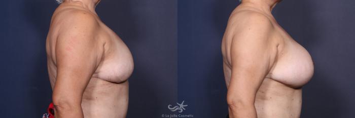 Before & After Revision Breast Surgery Result 126 Right Side View in San Diego, Carlsbad, CA