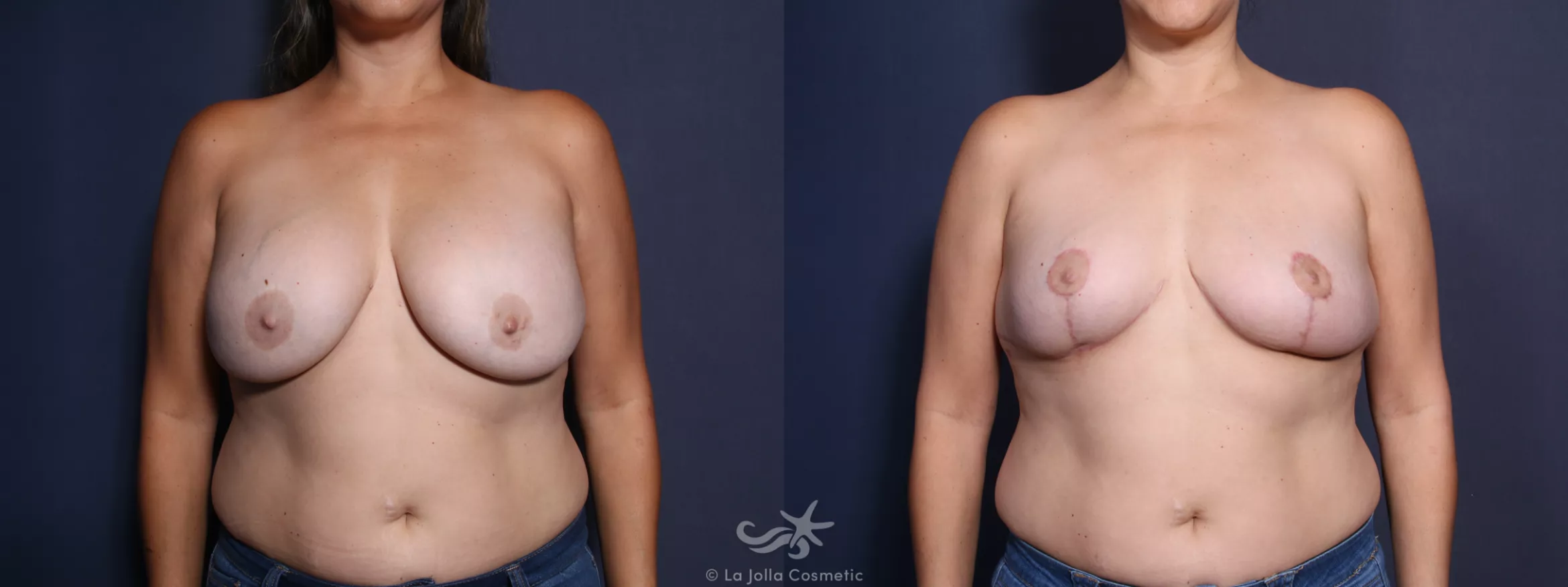Before & After Breast Implant Removal Result 13 Front View in San Diego, CA