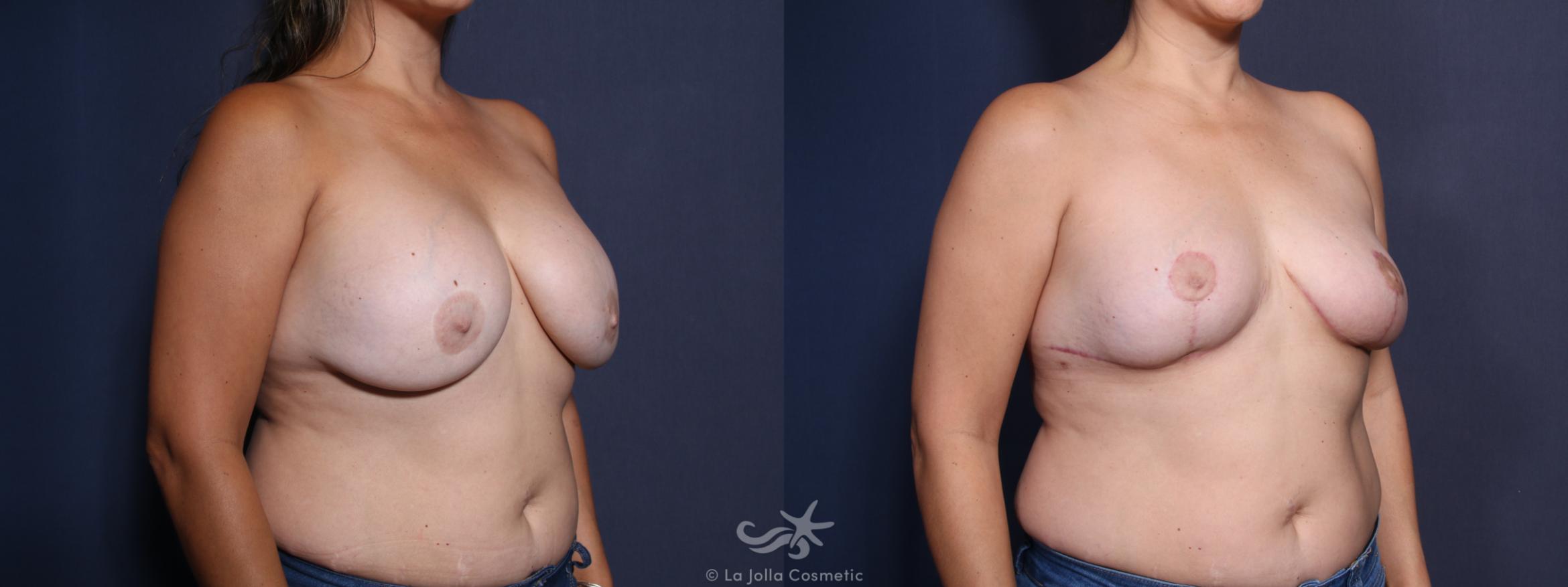 Before & After Revision Breast Surgery Result 13 Right Oblique View in San Diego, CA
