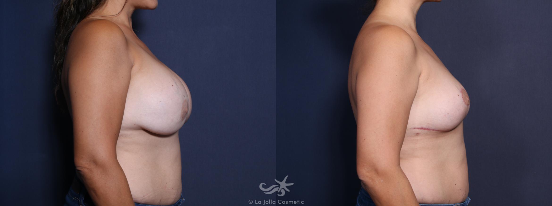 Before & After Revision Breast Surgery Result 13 Right Side View in San Diego, CA