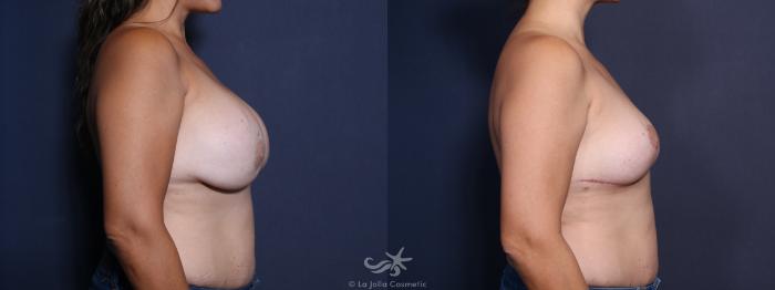 Before & After Revision Breast Surgery Result 13 Right Side View in San Diego, Carlsbad, CA