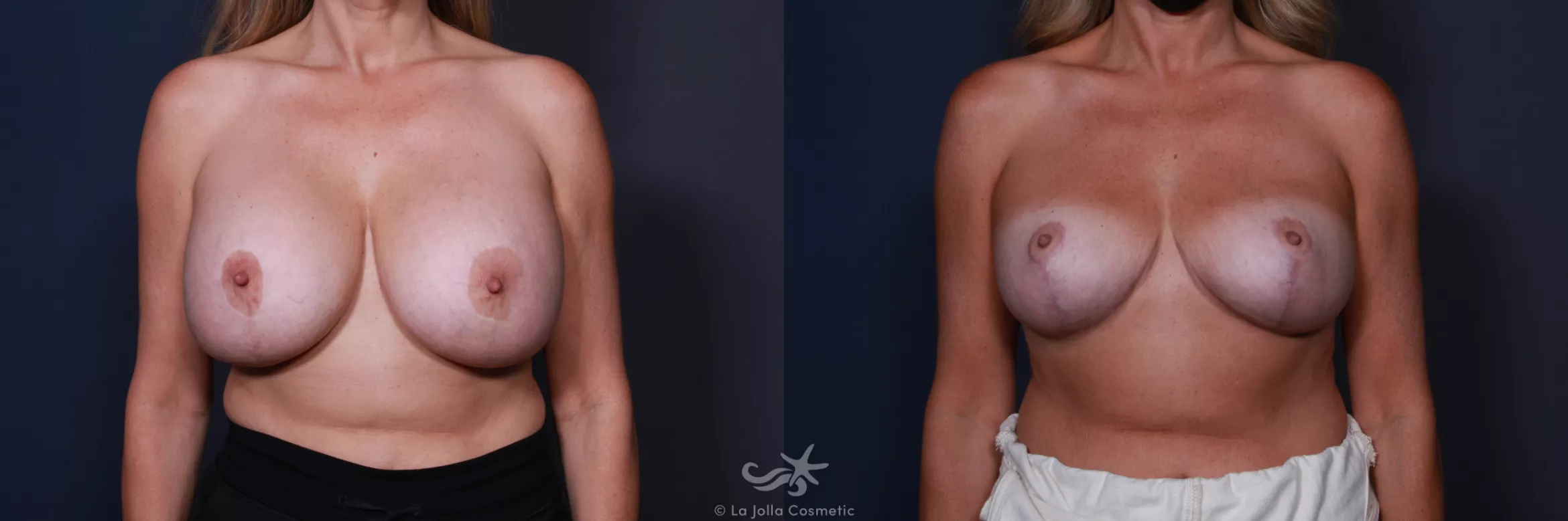 Before & After Revision Breast Surgery Result 185 Front View in San Diego, CA