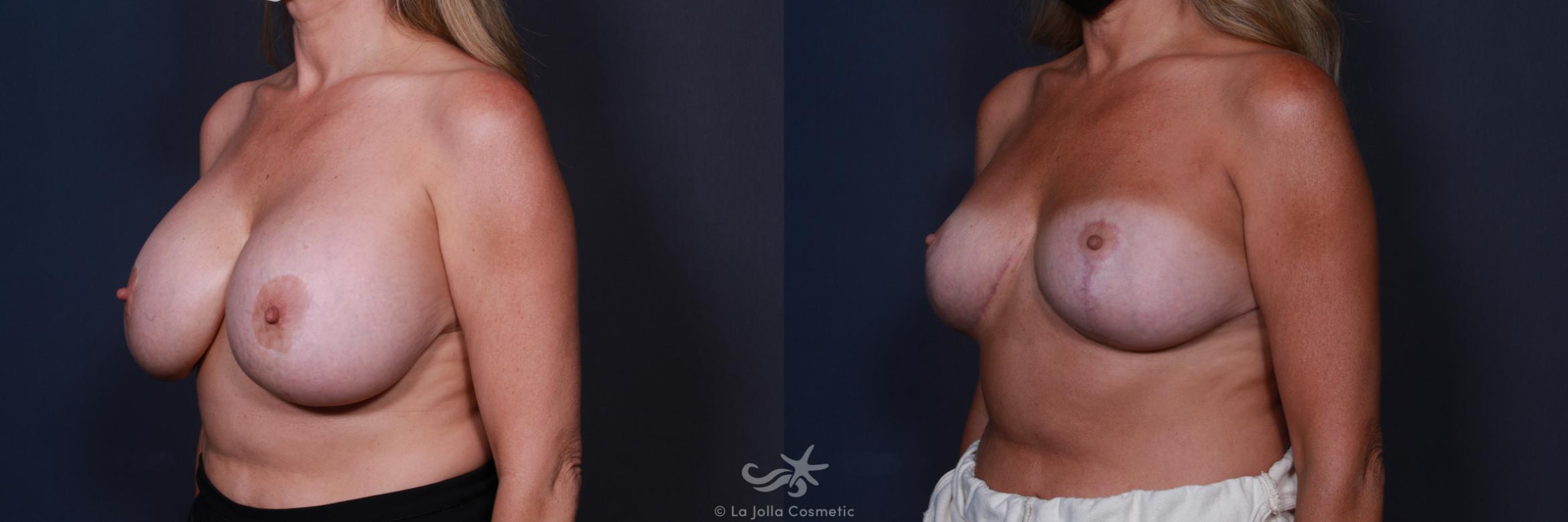 Before & After Revision Breast Surgery Result 185 Left Oblique View in San Diego, CA