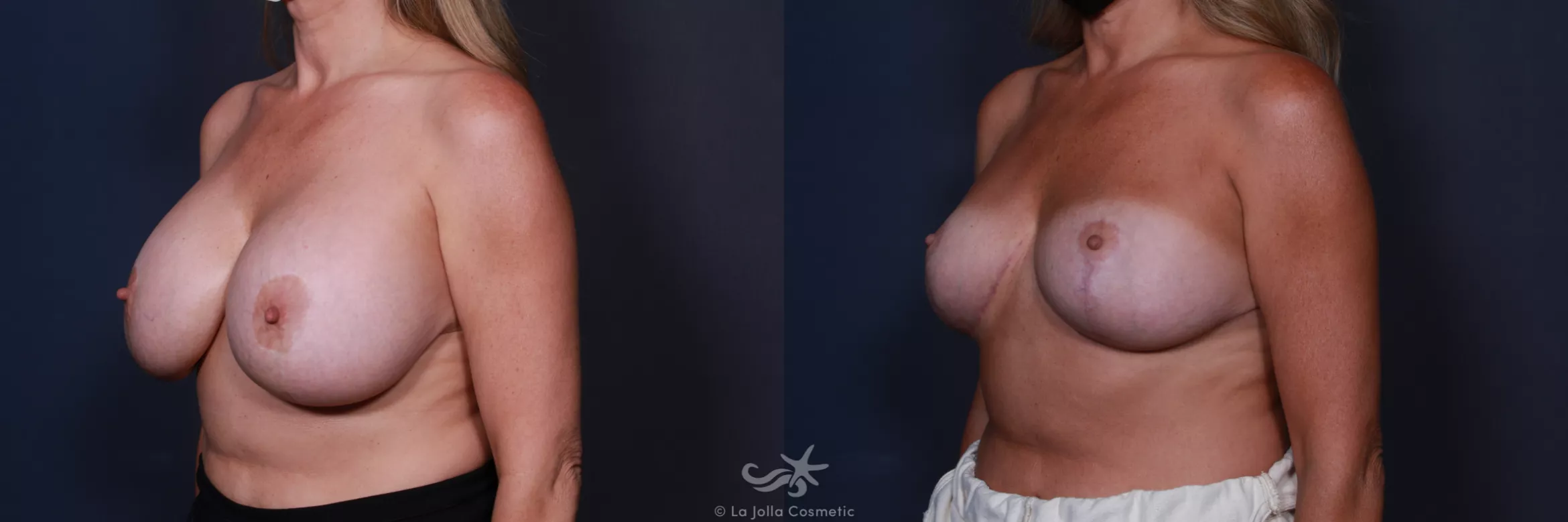 Before & After Revision Breast Surgery Result 185 Left Oblique View in San Diego, CA