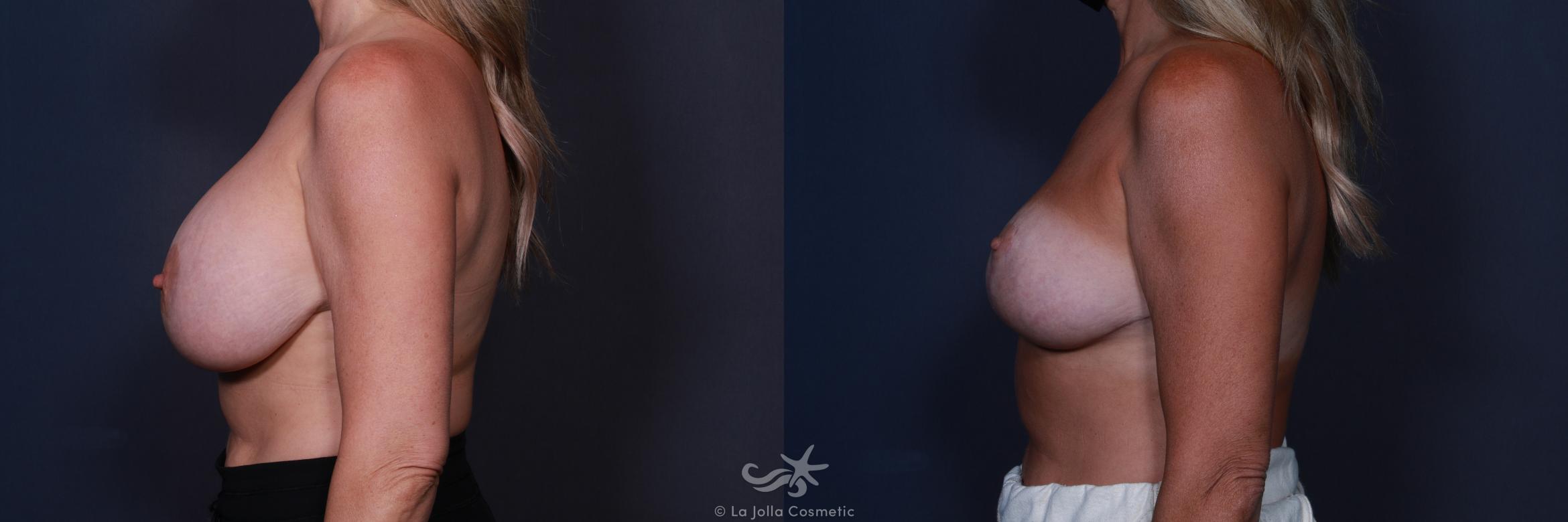 Before & After Revision Breast Surgery Result 185 Left Side View in San Diego, CA
