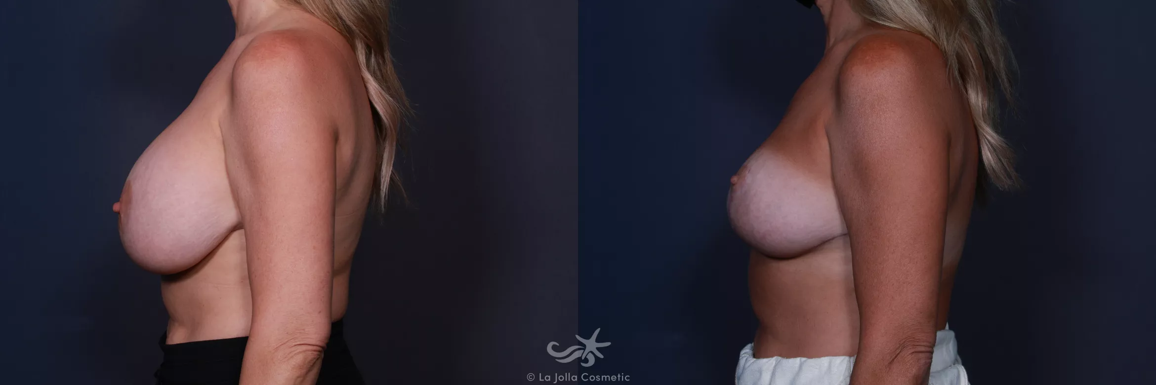Before & After Revision Breast Surgery Result 185 Left Side View in San Diego, CA