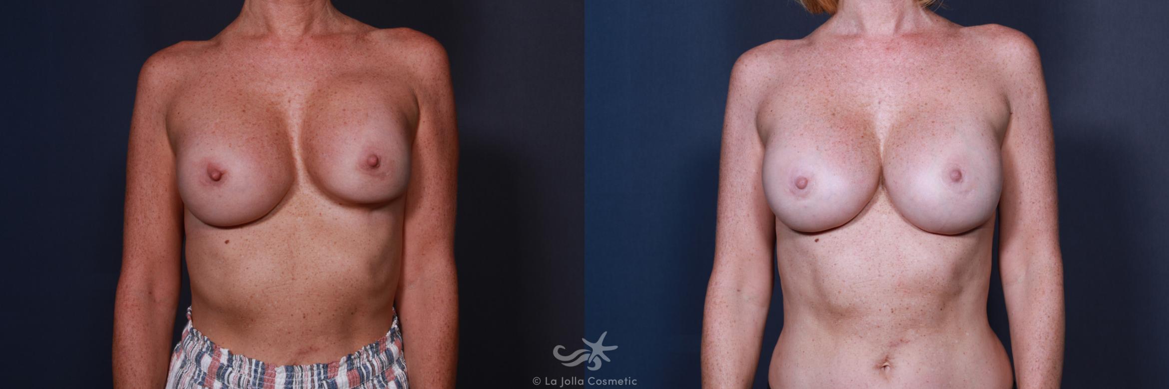 Before & After Revision Breast Surgery Result 582 Front View in San Diego, CA