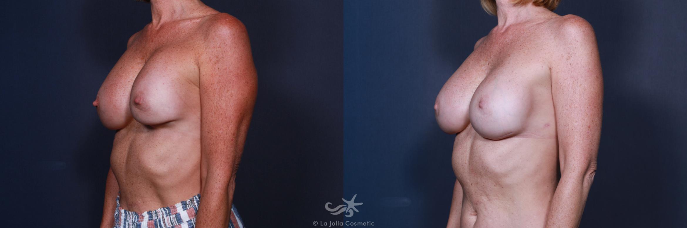 Before & After Revision Breast Surgery Result 582 Left Oblique View in San Diego, CA