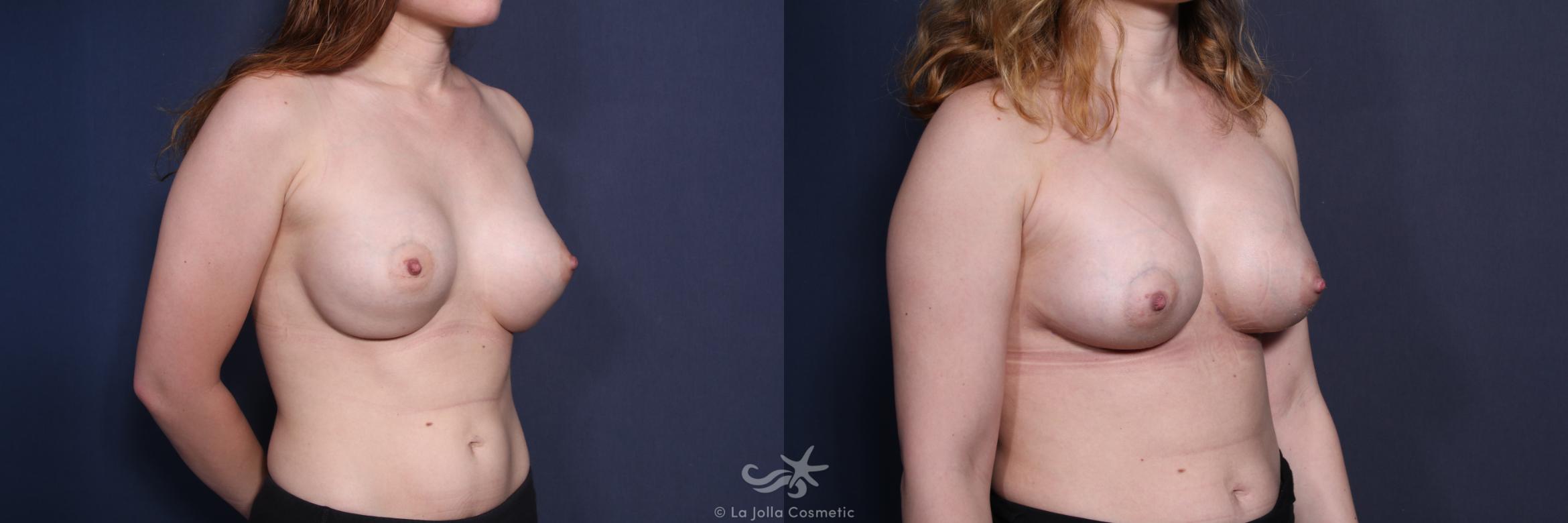 Before & After Revision Breast Surgery Result 72 Right Oblique View in San Diego, CA
