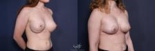 Before & After Revision Breast Surgery Result 72 Right Oblique View in San Diego, Carlsbad, CA