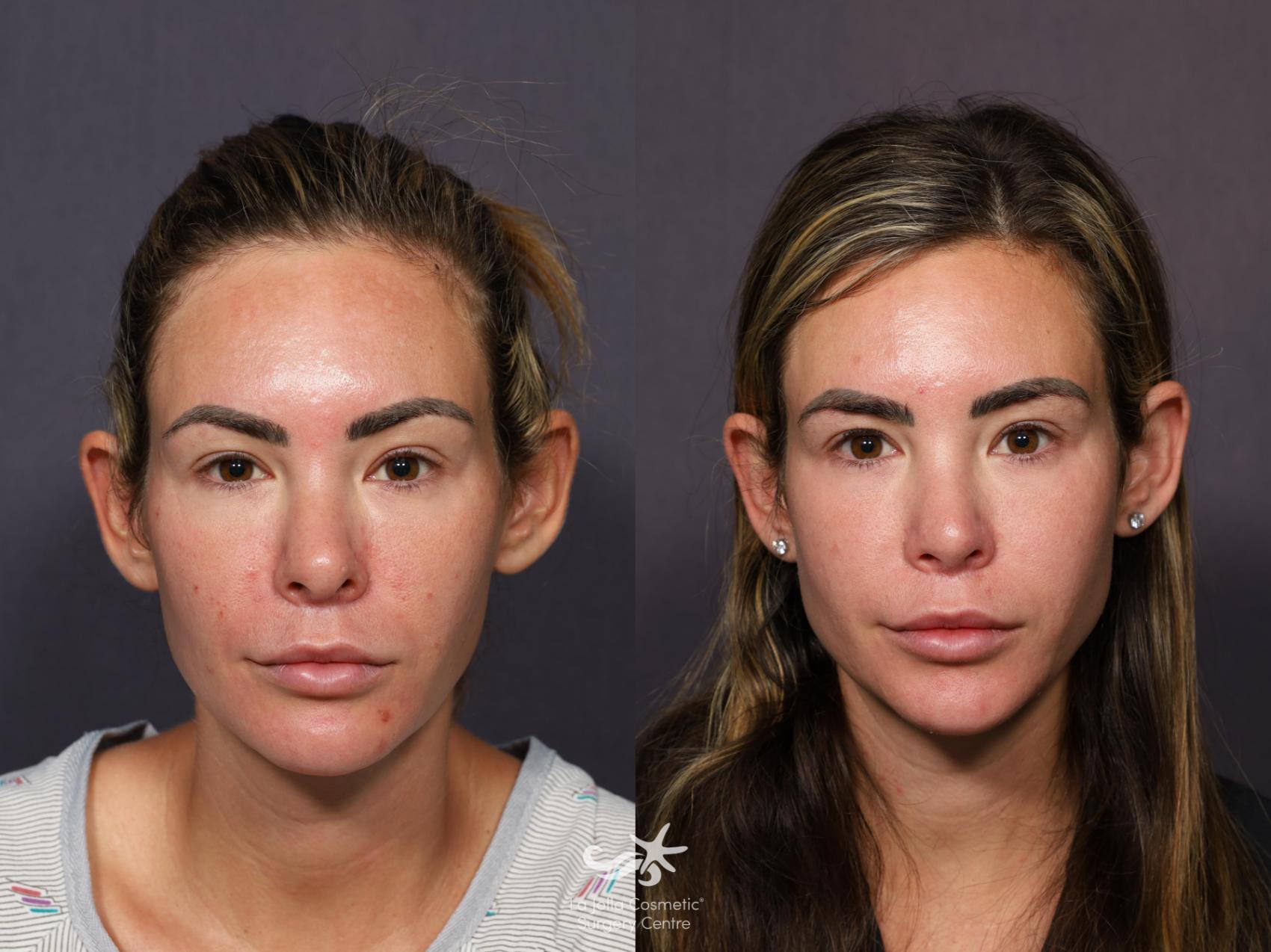 Before & After Revision Rhinoplasty Result 1131 Front View in San Diego, CA