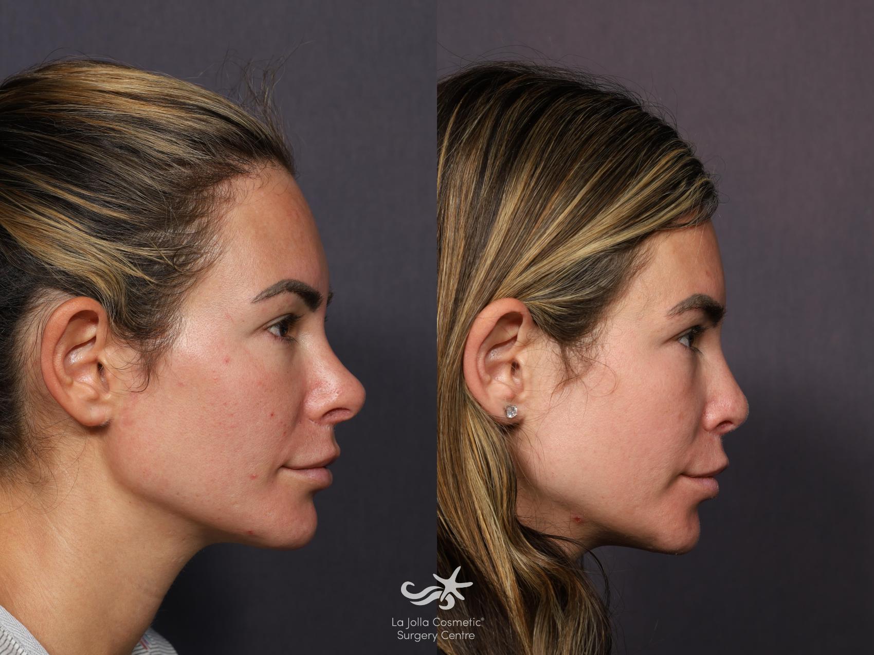 Before & After Revision Rhinoplasty Result 1131 Right Side View in San Diego, CA