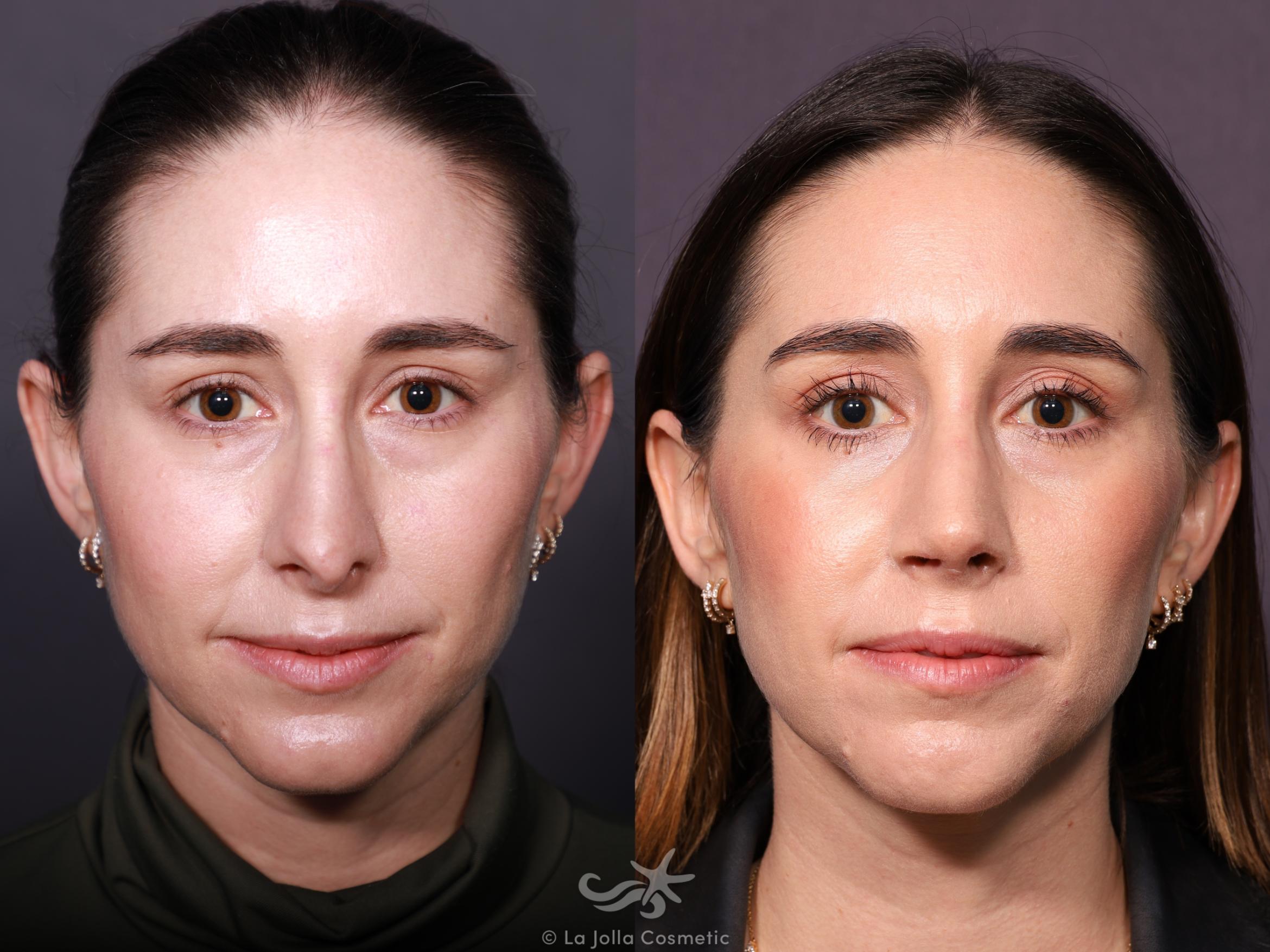 Before & After Revision Rhinoplasty Result 657 Front View in San Diego, CA