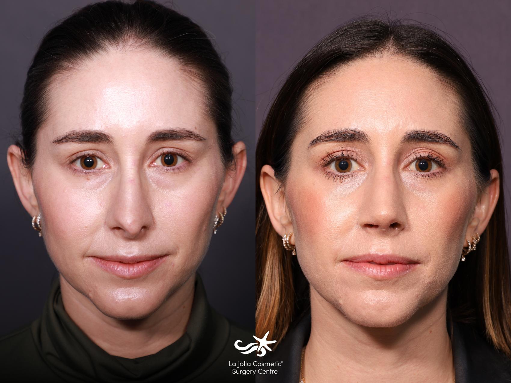 Before & After Revision Rhinoplasty Result 657 Front View in San Diego, CA