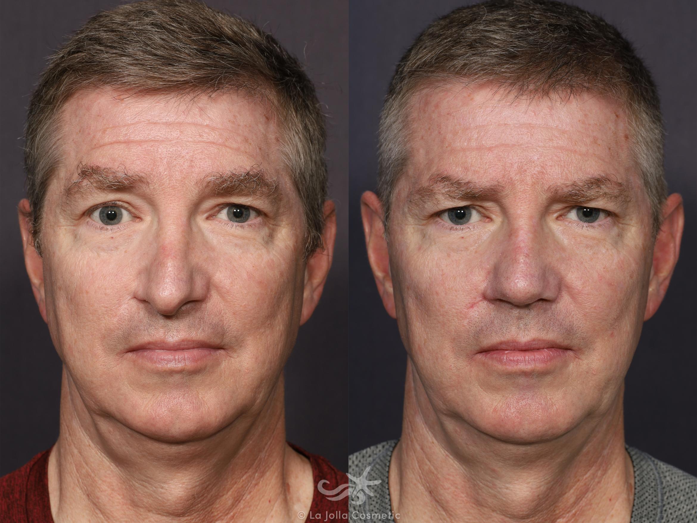 Before & After Revision Rhinoplasty Result 711 Front View in San Diego, CA