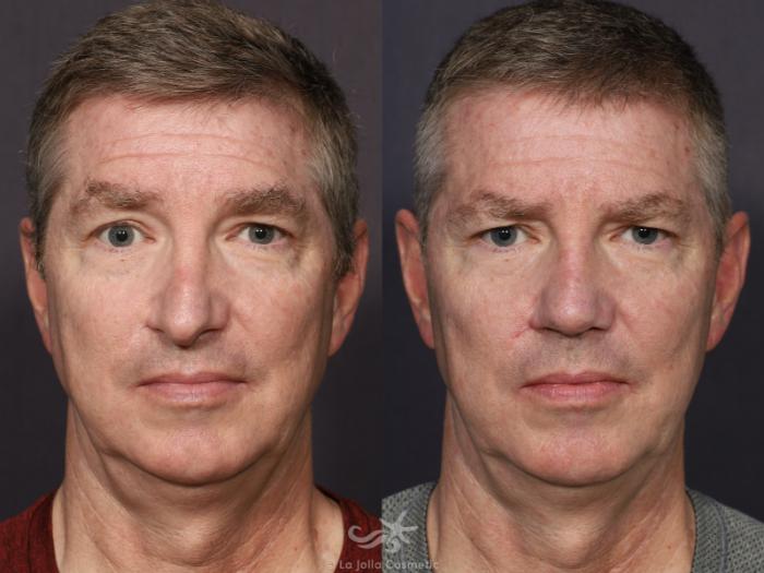 Before & After Scar Treatment Result 711 Front View in San Diego, Carlsbad, CA
