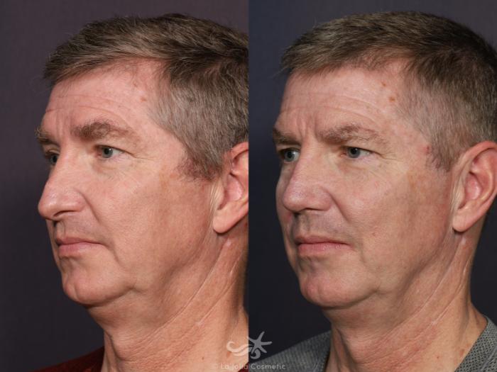 Before & After Revision Rhinoplasty Result 711 Left Oblique View in San Diego, Carlsbad, CA