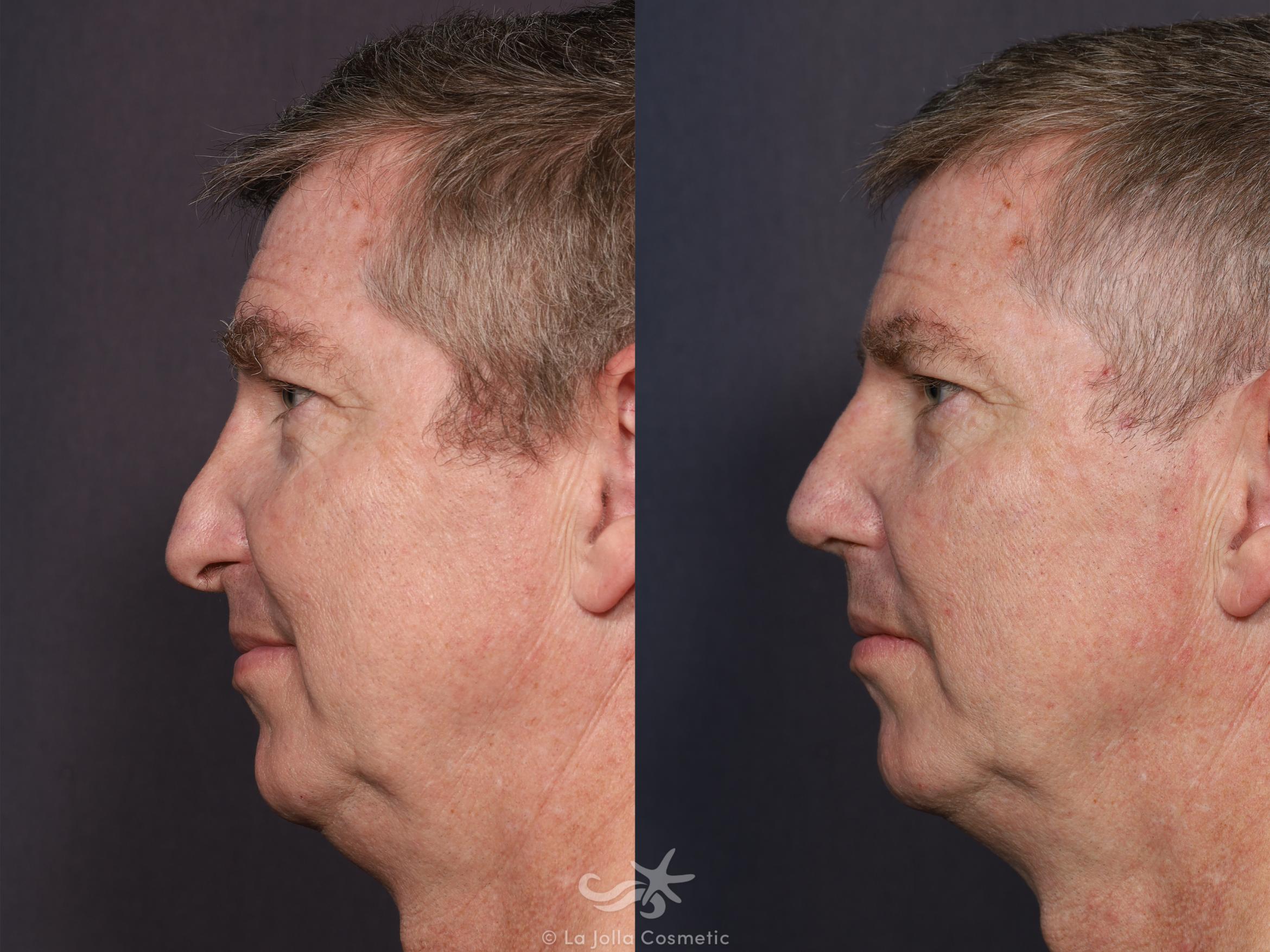 Before & After Revision Rhinoplasty Result 711 Left Side View in San Diego, CA