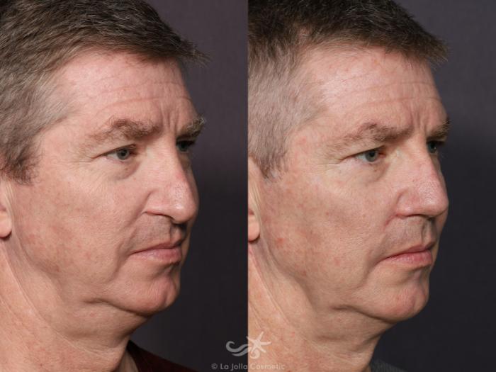 Before & After Revision Rhinoplasty Result 711 Right Oblique View in San Diego, Carlsbad, CA